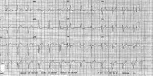 ECG 6