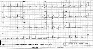 ECG 8