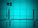 ECG workshop: aVR and all that