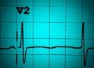 ECG workshop: aVR and all that