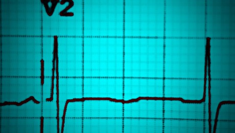 ECG workshop: aVR and all that