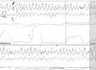 Personalising CPR Developing EM