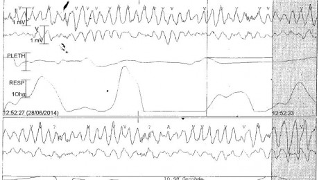 Personalising CPR Developing EM