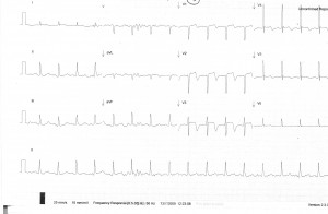 ECG wk 4