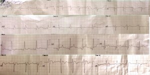 ECG9.1