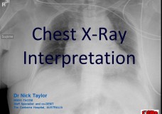 TiCME CXR Interpretation