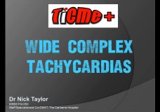 Wide Complex Tachycardias