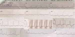 ECG 9.2